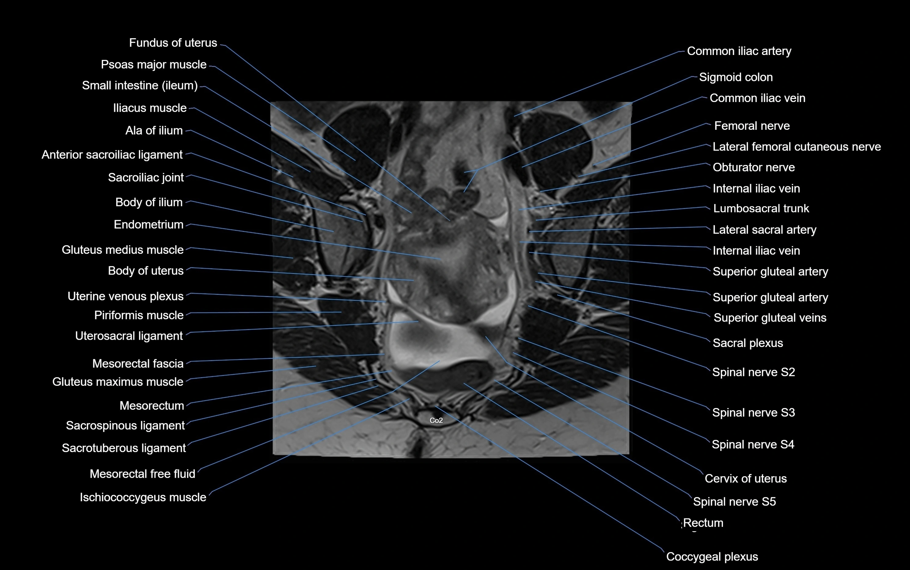 MRI sacroiliac joint coronal cross sectional anatomy  radiology  image-img-00001-00008.webp